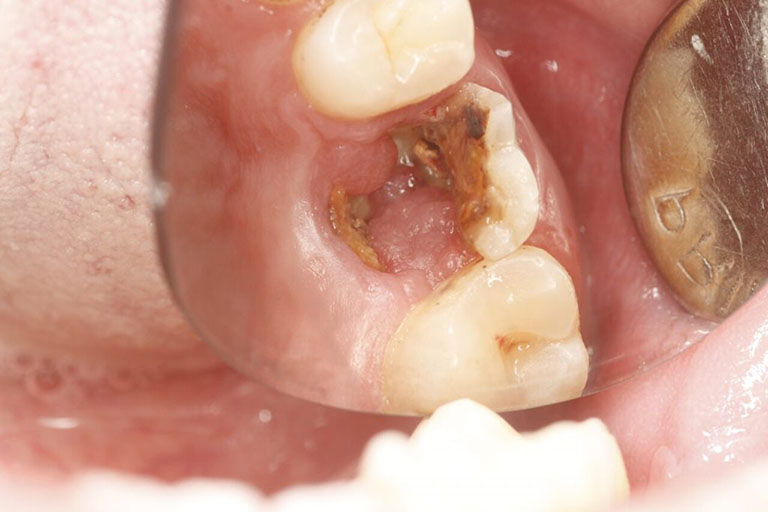 Cách lấp lỗ sâu răng tại nhà: Giải pháp tạm thời và lưu ý quan trọng