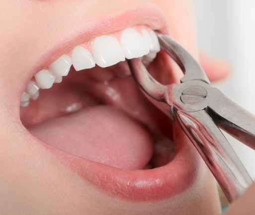 Sâu răng gây sốt: Nguyên nhân, mức độ nguy hiểm và cách xử lý hiệu quả