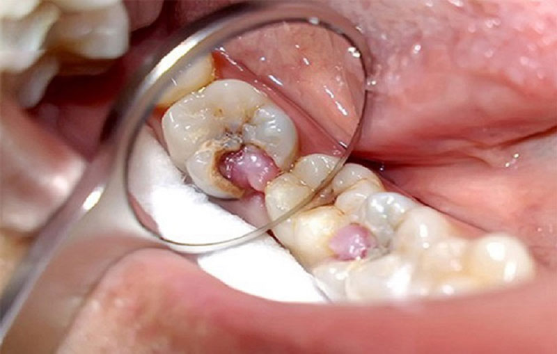 Sâu răng gây sốt: Nguyên nhân, mức độ nguy hiểm và cách xử lý hiệu quả